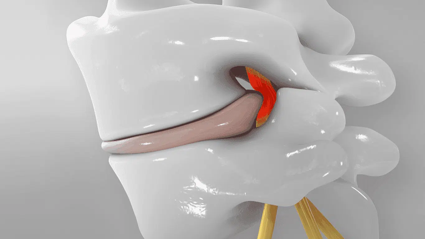 Nucleoplastia endoscópica percutánea